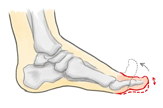 Grafik Hallux rigidus